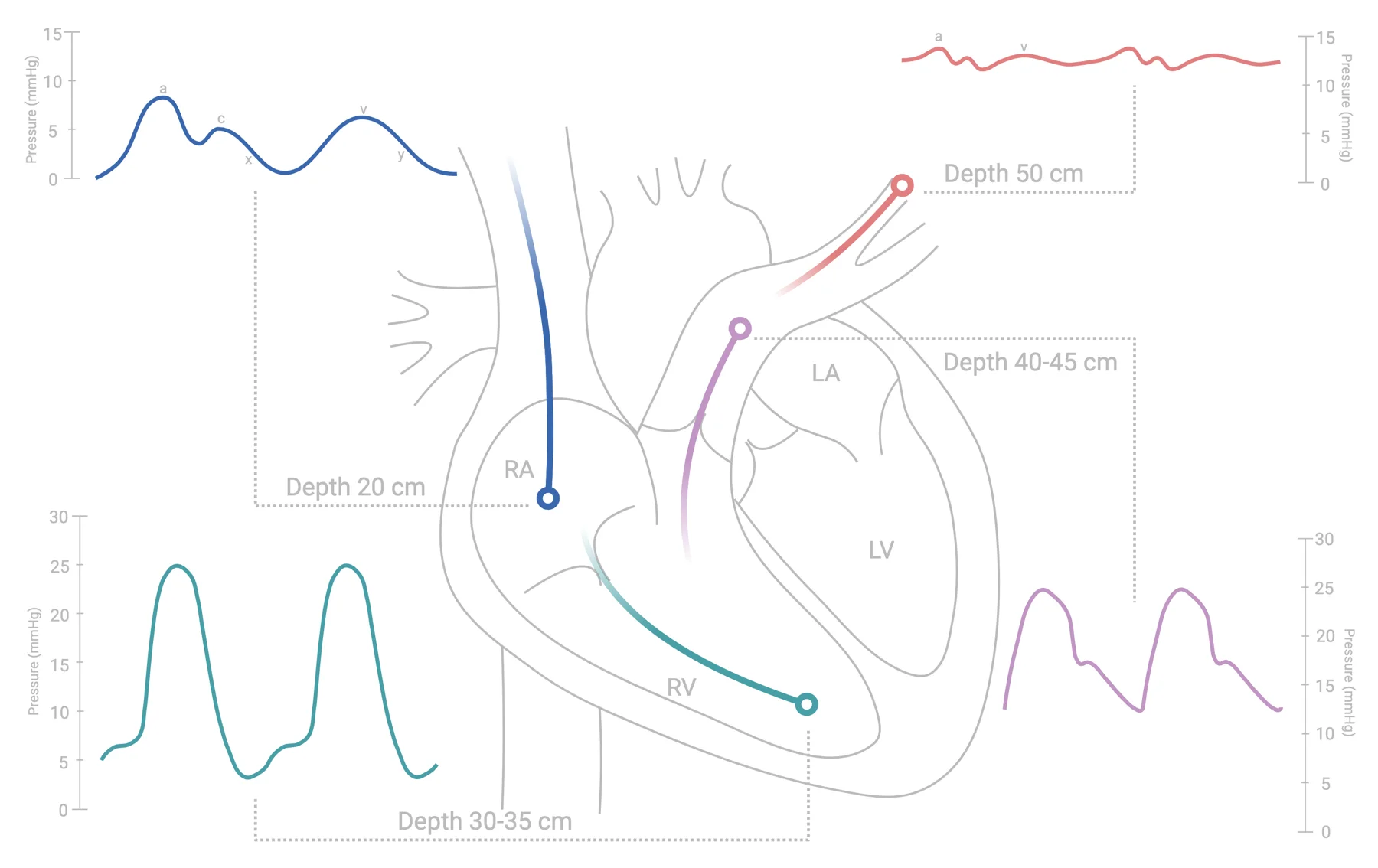 Pulmonary artery catheter positions in the right heart with the pressure waveform recorded at each depth